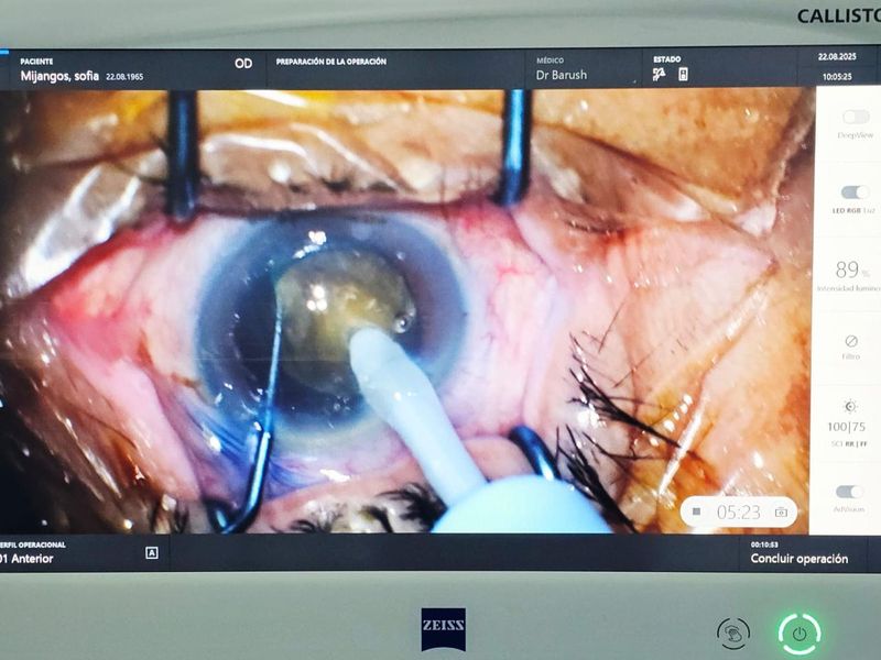 Cirugía de cataratas con equipo Zeiss en Oaxaca — Centro Oftalmológico Aether