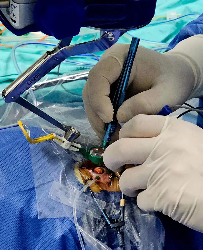 Detalle de cirugía ocular de alta precisión