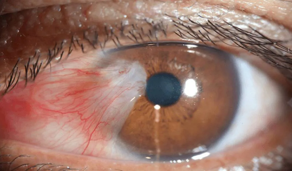 Pterigión — crecimiento fibrovascular sobre la córnea (foto clínica)