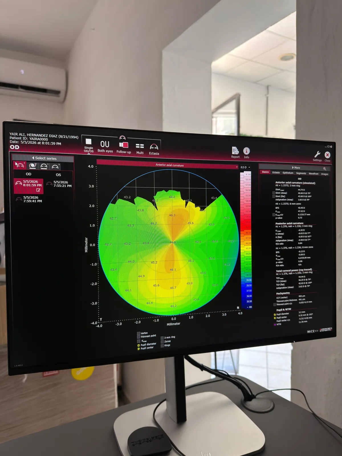 Topografía corneal axial en Oaxaca